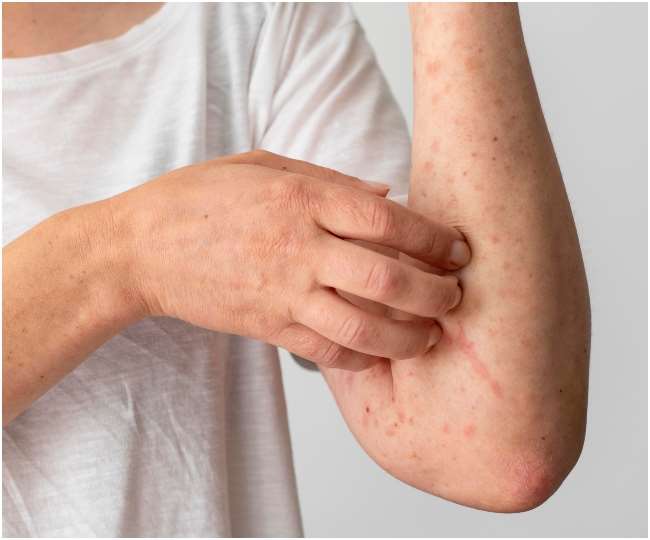 त्वचा की खुजली को न करें नजरअंदाज, हो सकता है Atopic dermatitis का खतरा