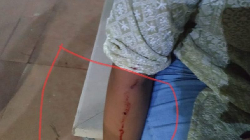 Greater Noida Supertech Society Dog Bite: पार्क में वाॅक कर रही महिला को कुत्ते ने काटा, दिखे दांत के निशान