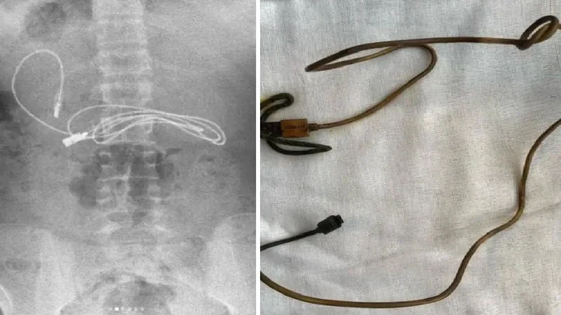 Turkey news: बच्चे के पेट में से निकली चार्जिंग केबल, एक्स-रे में दिखी तस्वीर