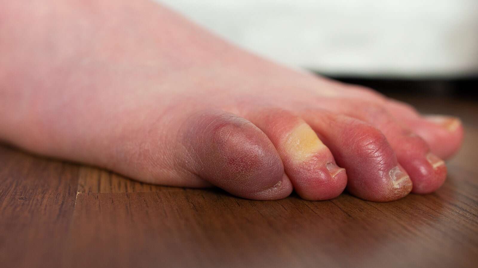 Swelling in fingers in winter: सर्दियों में पैरों की उंगलियों में है सूजन, जल्द करें ये उपाय