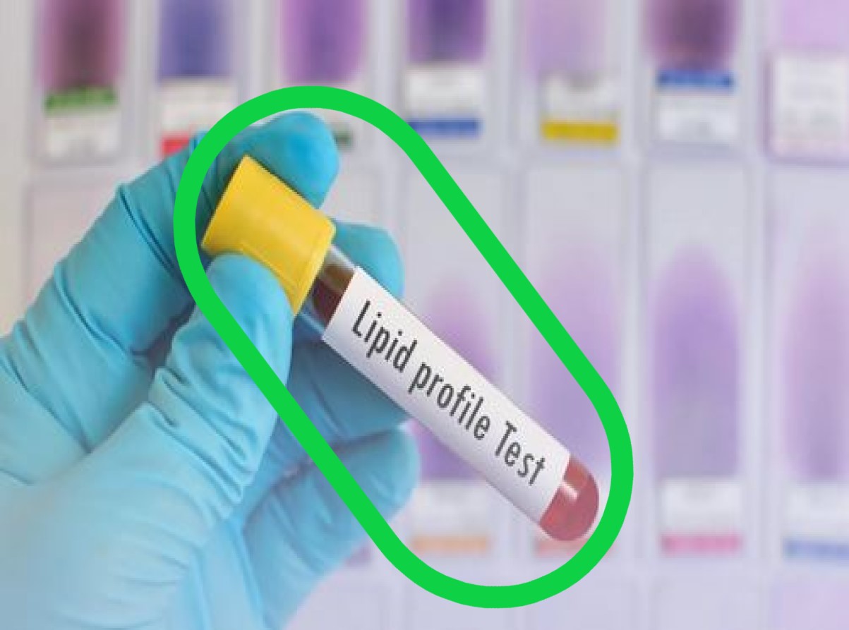 High Cholesterol Test: क्या आपके हार्ट पर मडरा रहा है खतरा.. लिपिड प्रोफाइल टेस्ट से इस तरह पता करें