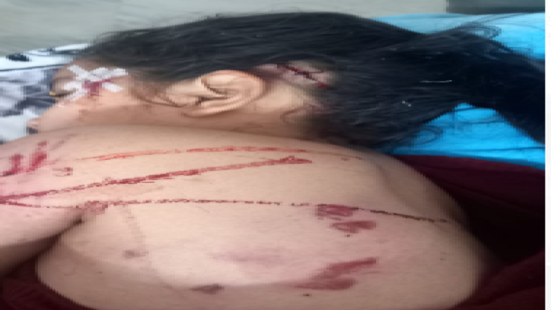 Dog Attack in Delhi: बच्ची पर खूंखार पिटबुल ने किया हमला, परिजनों ने शिकायत दर्ज करा निकाली मशाल यात्रा