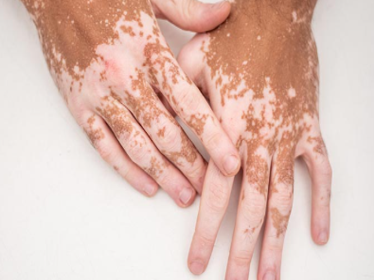 Food Avoid In Vitiligo: इन चीजों को खाने से बढ़ सकती है विटिलिगो बीमारी, आज ही करें अवॉइड