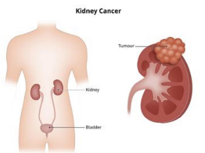 Kidney Cancer Symptoms: किडनी कैंसर के शुरुआती स्टेज में शरीर में नजर आते हैं ये लक्षण, ऐसे करें पहचान