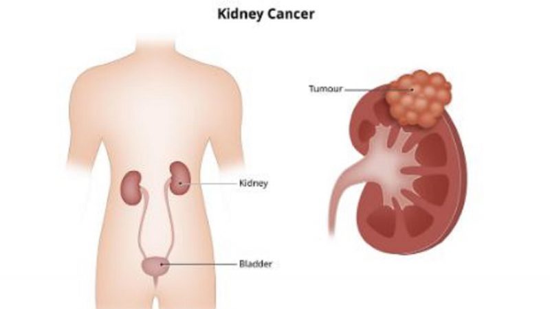 Kidney Cancer Symptoms: किडनी कैंसर के शुरुआती स्टेज में शरीर में नजर आते हैं ये लक्षण, ऐसे करें पहचान