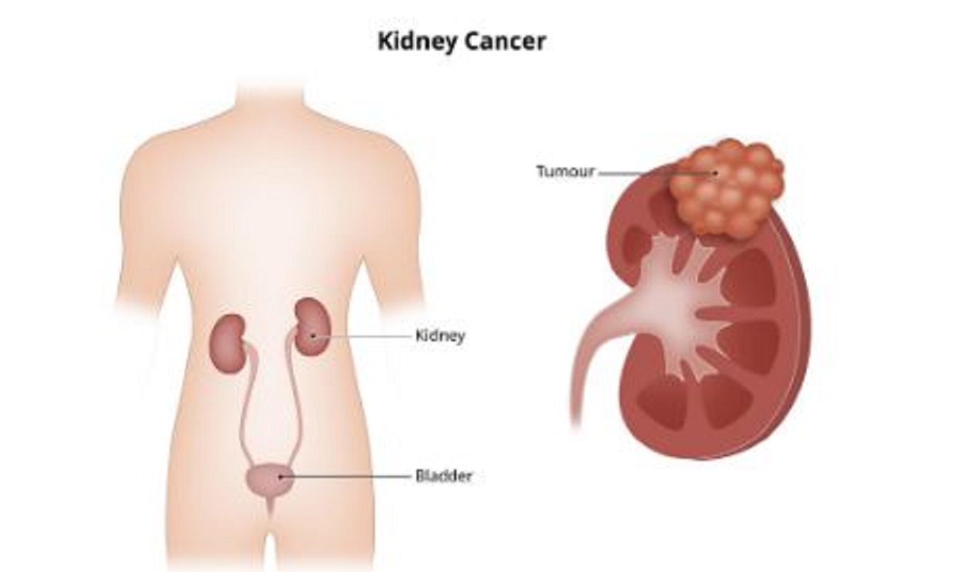 Kidney Cancer Symptoms: किडनी कैंसर के शुरुआती स्टेज में शरीर में नजर आते हैं ये लक्षण, ऐसे करें पहचान